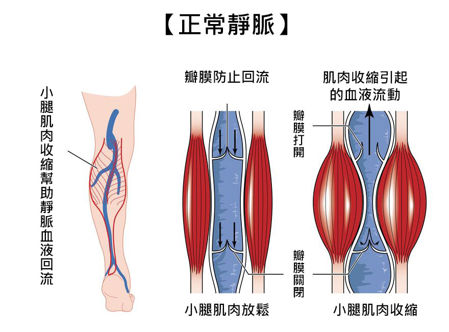 靜脈曲張，小腿肌肉收縮幫助靜脈血液回流